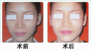 三次果酸相当于一次光子嫩肤：果酸嫩肤，三次等于一次光子嫩肤？