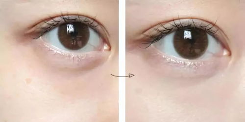60岁还有必要做眼袋吗:60岁还能做眼袋吗?这些真相你一定要知道! 60岁还有必要做眼袋吗:60岁还能做眼袋吗?这些真相你一定要知道!