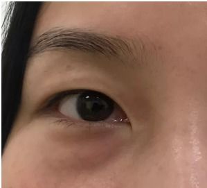 60岁还有必要做眼袋吗:60岁还能做眼袋吗?这些真相你一定要知道! 60岁还有必要做眼袋吗:60岁还能做眼袋吗?这些真相你一定要知道!