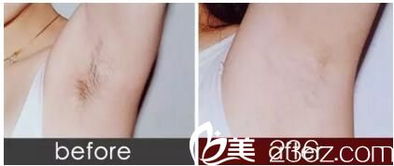 激光脱毛挂什么科:激光脱毛挂错科室?这些科室信息请收好! 激光脱毛挂什么科:激光脱毛挂错科室?这些科室信息请收好!