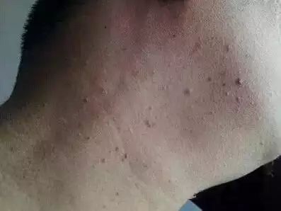 丝状疣初期图片:警惕!丝状疣初期长什么样?这些图片和特征要了解 丝状疣初期图片:警惕!丝状疣初期长什么样?这些图片和特征要了解