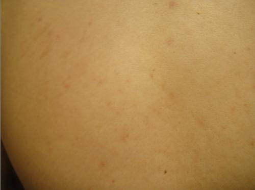 各种疹子的症状图片:你真的能分清这些疹子吗?图文对照,帮你快速识别常见皮疹! 各种疹子的症状图片:你真的能分清这些疹子吗?图文对照,帮你快速识别常见皮疹!