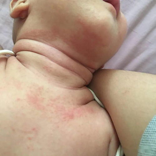 各种疹子的症状图片:你真的能分清这些疹子吗?图文对照,帮你快速识别常见皮疹! 各种疹子的症状图片:你真的能分清这些疹子吗?图文对照,帮你快速识别常见皮疹!