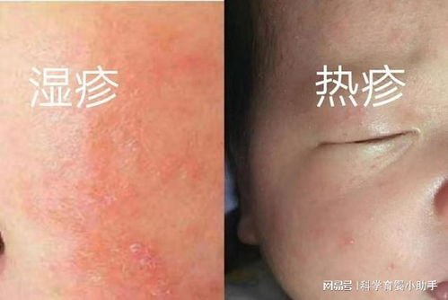 各种疹子的症状图片:你真的能分清这些疹子吗?图文对照,帮你快速识别常见皮疹! 各种疹子的症状图片:你真的能分清这些疹子吗?图文对照,帮你快速识别常见皮疹!