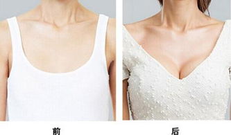 假体隆胸取出可以马上填充脂肪吗:假体隆胸取出后可以马上填充脂肪吗? 假体隆胸取出可以马上填充脂肪吗:假体隆胸取出后可以马上填充脂肪吗?