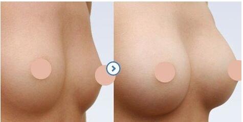 假体隆胸取出可以马上填充脂肪吗:假体隆胸取出后可以马上填充脂肪吗? 假体隆胸取出可以马上填充脂肪吗:假体隆胸取出后可以马上填充脂肪吗?