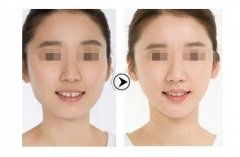 做整容手术多少钱啊：整容手术价格大揭秘，从几万到几十万，你需要知道的真相