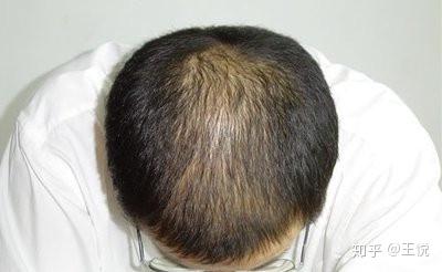 安体舒通治疗脱发:安体舒通治脱发?效果真的好吗? 安体舒通治疗脱发:安体舒通治脱发?效果真的好吗?