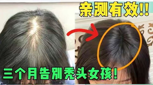 安体舒通治疗脱发:安体舒通治脱发?效果真的好吗? 安体舒通治疗脱发:安体舒通治脱发?效果真的好吗?