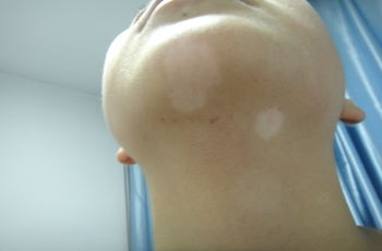 世界最新治疗白斑的方法:白斑治疗新突破,全球医学界最新进展与临床应用 世界最新治疗白斑的方法:白斑治疗新突破,全球医学界最新进展与临床应用