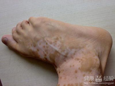 世界最新治疗白斑的方法:白斑治疗新突破,全球医学界最新进展与临床应用 世界最新治疗白斑的方法:白斑治疗新突破,全球医学界最新进展与临床应用