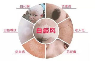 世界最新治疗白斑的方法:白斑治疗新突破,全球医学界最新进展与临床应用 世界最新治疗白斑的方法:白斑治疗新突破,全球医学界最新进展与临床应用