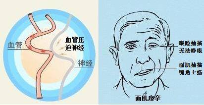 面肌痉挛治疗最好的医院:面肌痉挛治疗最好的医院是哪家?