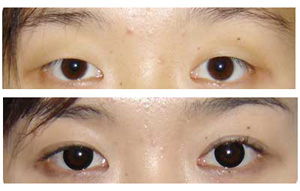 无痕双眼皮大概要多少钱:无痕双眼皮手术价格参考,了解费用构成与市场行情