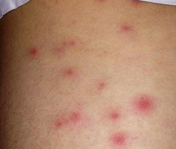 红霉素能不能涂在烂的伤口上:红霉素能否用于治疗严重或烂伤口?