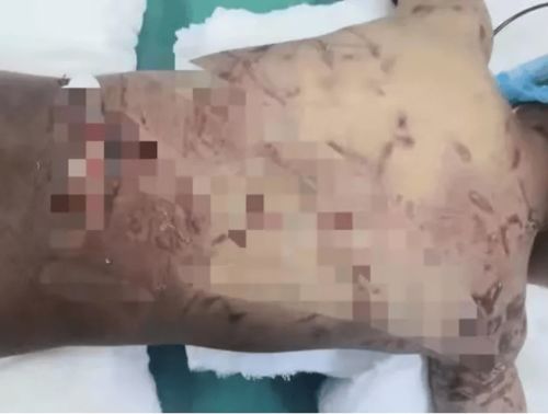 千万别把丝状疣想象的太严重:千万别把丝状疣想象的太严重,认识这种常见皮肤问题,科学应对不焦虑 千万别把丝状疣想象的太严重:千万别把丝状疣想象的太严重,认识这种常见皮肤问题,科学应对不焦虑