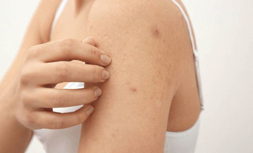 千万别把丝状疣想象的太严重:千万别把丝状疣想象的太严重,认识这种常见皮肤问题,科学应对不焦虑 千万别把丝状疣想象的太严重:千万别把丝状疣想象的太严重,认识这种常见皮肤问题,科学应对不焦虑