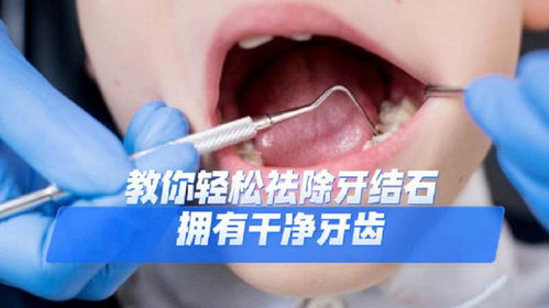 牙石怎么去掉小妙招:牙石困扰?这些小妙招轻松搞定!