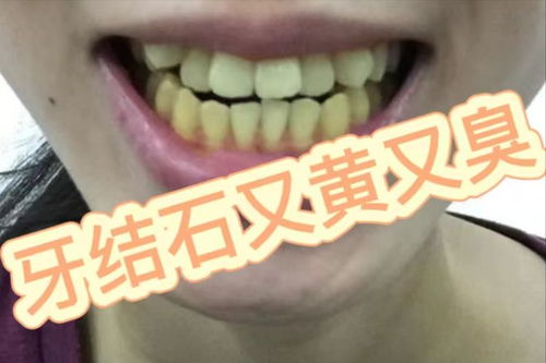 牙石怎么去掉小妙招：牙石困扰？这些小妙招轻松搞定！