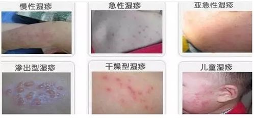 湿疹怎么治才能除根:湿疹怎么治才能除根?这5个方法帮你彻底摆脱困扰 湿疹怎么治才能除根:湿疹怎么治才能除根?这5个方法帮你彻底摆脱困扰