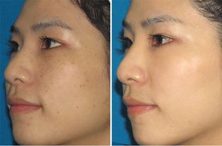 如何祛斑安全有效不反弹：祛斑安全有效不反弹，科学方法与日常护理全解析