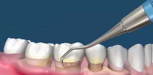 牙结石去除后牙缝变大怎么办:牙结石去除后牙缝变大怎么办?真相与解决方案全解析 牙结石去除后牙缝变大怎么办:牙结石去除后牙缝变大怎么办?真相与解决方案全解析