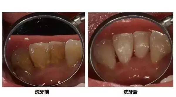 牙结石去除后牙缝变大怎么办:牙结石去除后牙缝变大怎么办?真相与解决方案全解析 牙结石去除后牙缝变大怎么办:牙结石去除后牙缝变大怎么办?真相与解决方案全解析