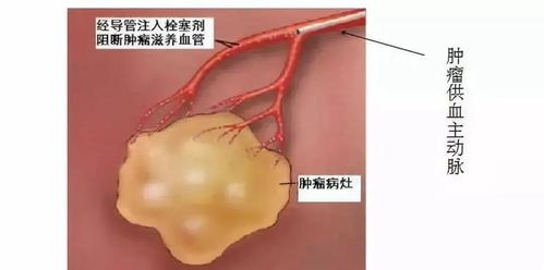 肝囊肿最佳治疗方法:肝囊肿最佳治疗方法解析,从观察到介入,精准选择是关键 肝囊肿最佳治疗方法:肝囊肿最佳治疗方法解析,从观察到介入,精准选择是关键