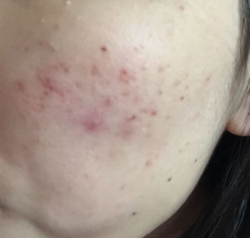 隐私左侧长了个疙瘩是怎么治：隐私左侧长了个疙瘩是怎么治？这些原因和应对方法要知道！