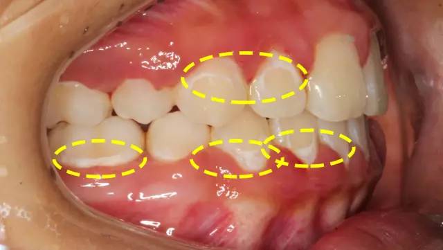 智齿都坏成大窟窿了还好拔吗:智齿都坏成大窟窿了,还好拔吗?牙医告诉你真相! 智齿都坏成大窟窿了还好拔吗:智齿都坏成大窟窿了,还好拔吗?牙医告诉你真相!