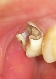 智齿都坏成大窟窿了还好拔吗:智齿都坏成大窟窿了,还好拔吗?牙医告诉你真相! 智齿都坏成大窟窿了还好拔吗:智齿都坏成大窟窿了,还好拔吗?牙医告诉你真相!