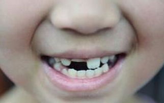 做梦梦见自己掉牙齿是什么预兆:梦里掉牙,你真的需要担心吗?