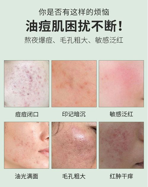 青春期粉刺如何快速有效消除：青春期粉刺困扰？这些快速有效的灭火方法请收好！