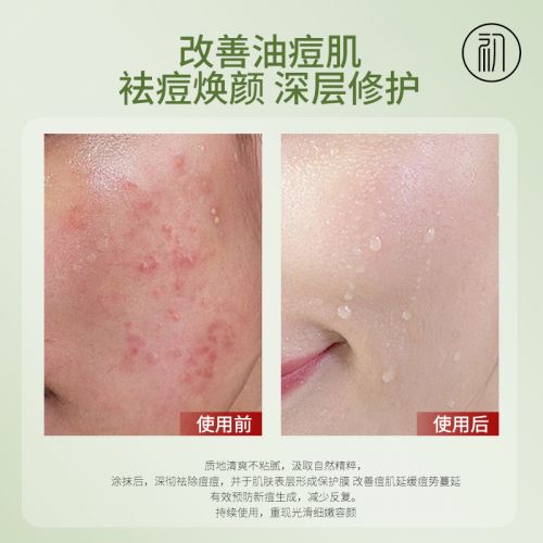 青春期粉刺如何快速有效消除：青春期粉刺困扰？这些快速有效的灭火方法请收好！