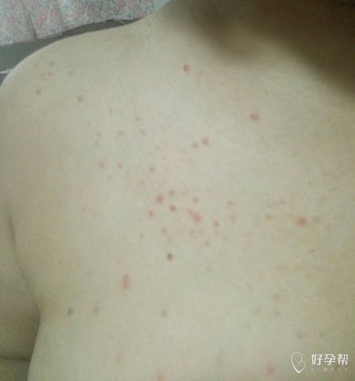 跳蚤咬的红疙瘩图片：跳蚤咬的红疙瘩图片，识别、症状与防治全图解