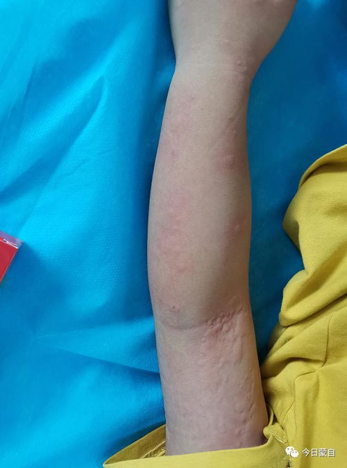 跳蚤咬的红疙瘩图片：跳蚤咬的红疙瘩图片，识别、症状与防治全图解