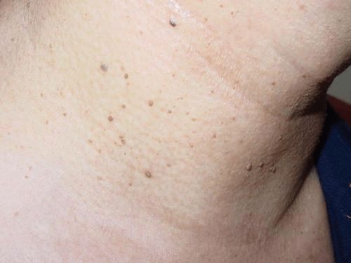 hpv病毒怎么才能彻底清除：HPV病毒如何彻底清除？这5种科学方法你必须知道！