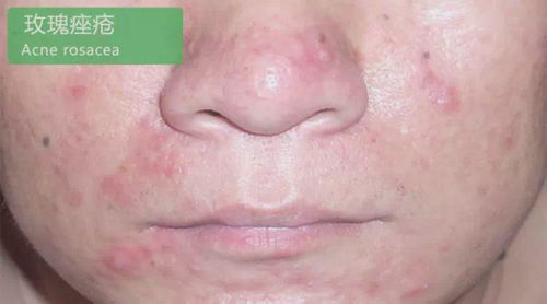 玫瑰痤疮图片：玫瑰痤疮，认识、症状与治疗全解析