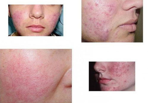 玫瑰痤疮图片：玫瑰痤疮，认识、症状与治疗全解析