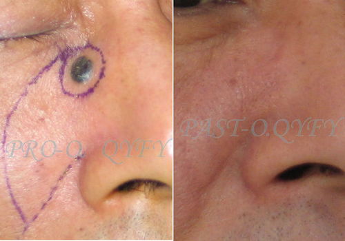 角膜炎有哪些症状：警惕角膜炎！这些症状不可忽视，早发现早治疗是关键