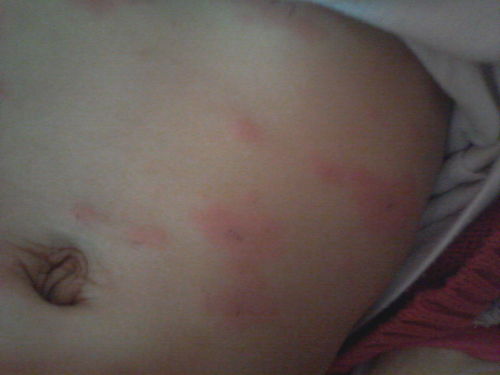 丘疹性荨麻疹真实照片：丘疹性荨麻疹真实照片，原来长这样！案例分享与症状解析