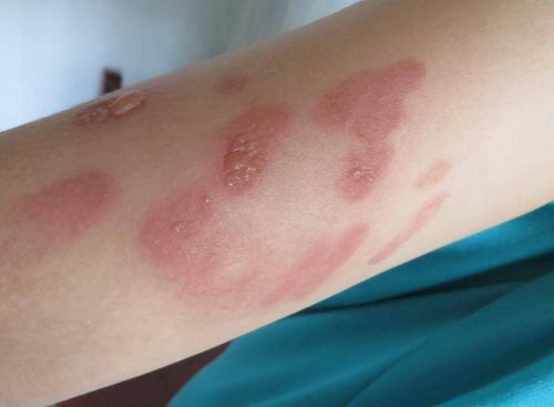 丘疹性荨麻疹真实照片：丘疹性荨麻疹真实照片，原来长这样！案例分享与症状解析