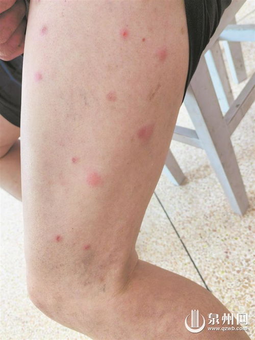 丘疹性荨麻疹真实照片：丘疹性荨麻疹真实照片，原来长这样！案例分享与症状解析