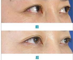 眼部细纹消除妙招偏方：眼部细纹消除妙招偏方，这些家庭护理方法值得一试！