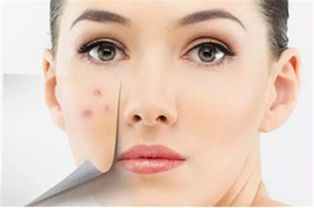 激光祛痘印多少钱：激光祛痘印到底要花多少钱？全解析，让你不再迷茫！