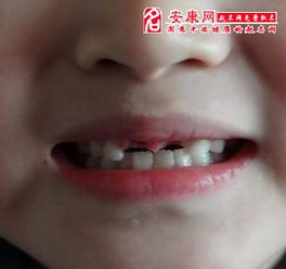 女人梦见上面牙掉了一颗：女人梦见上面牙掉了一颗，民间说法与心理解读的双重启示