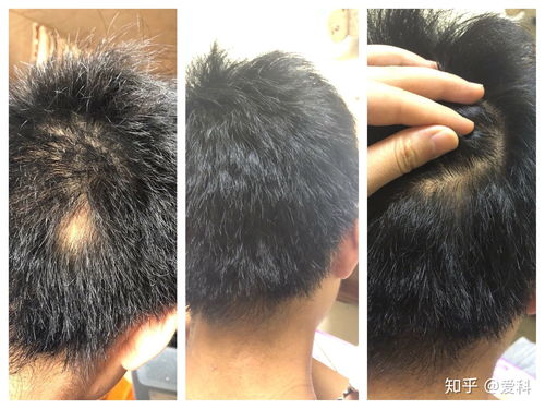 斑秃用生姜擦有用吗:斑秃用生姜擦有用吗?民间偏方与科学真相