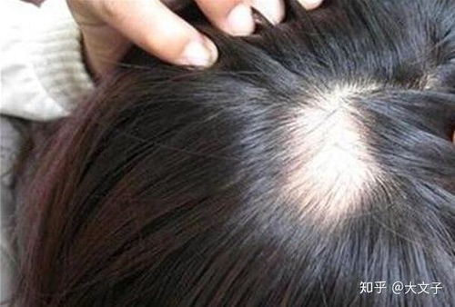 斑秃用生姜擦有用吗：斑秃用生姜擦有用吗？民间偏方与科学真相