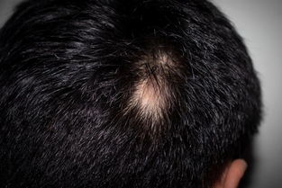 斑秃用生姜擦有用吗：斑秃用生姜擦有用吗？民间偏方与科学真相