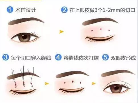 全切双眼皮1个月恢复图:全切双眼皮1个月恢复图,惊艳蜕变,真实案例全解析! 全切双眼皮1个月恢复图:全切双眼皮1个月恢复图,惊艳蜕变,真实案例全解析!